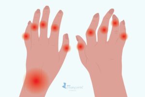 an illustration of hands showing red circles on joints. Some of the fingers are bent with RA joint changes.
